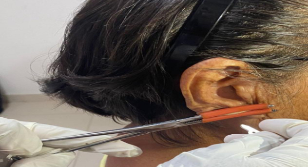 Sin casos nuevos de lepra en Oaxaca