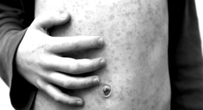 Sarampión en Oaxaca: detectan cuatro casos, todos dados de alta